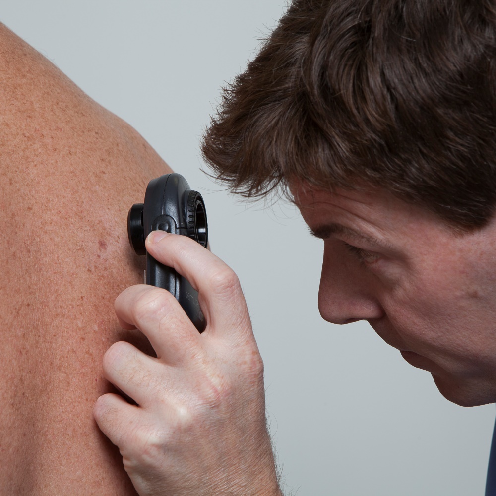 Mole and Cyst Removal Top Treatments at Cosmedics Skin Clinics